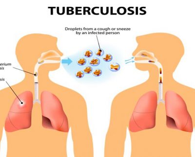 A Glimpse of the new global commitment to end tuberculosis